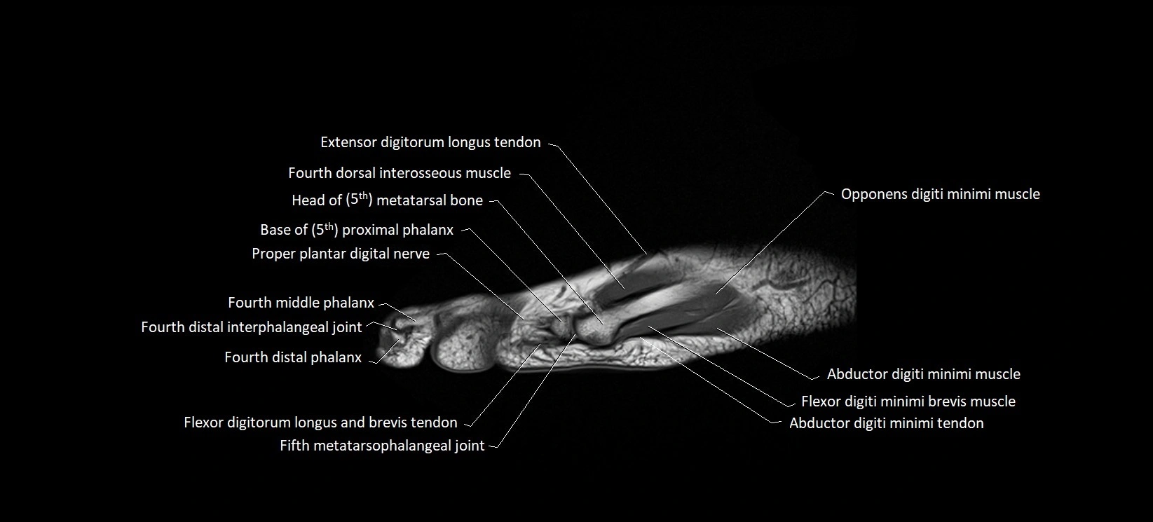 MRI foot sagittal labelled cross sectional anatomy image  22.webp